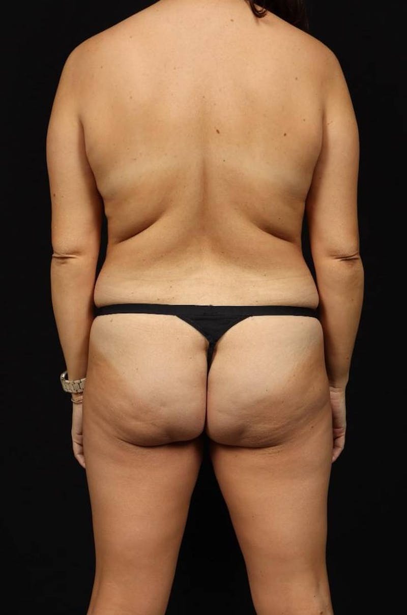 Mommy Makeover Before & After Gallery - Patient 323359 - Image 11
