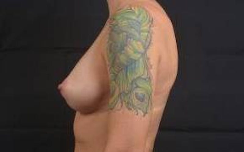 Immediate Breast Reconstruction – Skin Sparing Before & After Gallery - Patient 406784 - Image 3