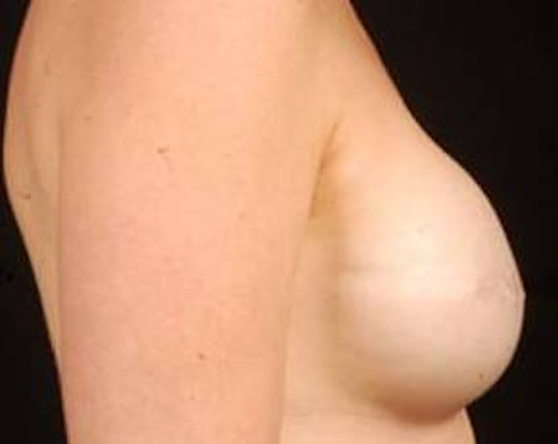 Reconstructive Breast Revision Before & After Gallery - Patient 345351 - Image 3