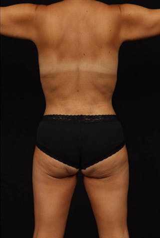 Mommy Makeover Before & After Gallery - Patient 323359 - Image 12