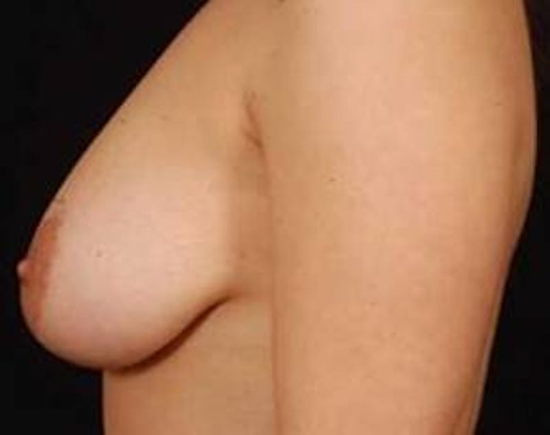 Mastopexy Before & After Gallery - Patient 368414 - Image 3