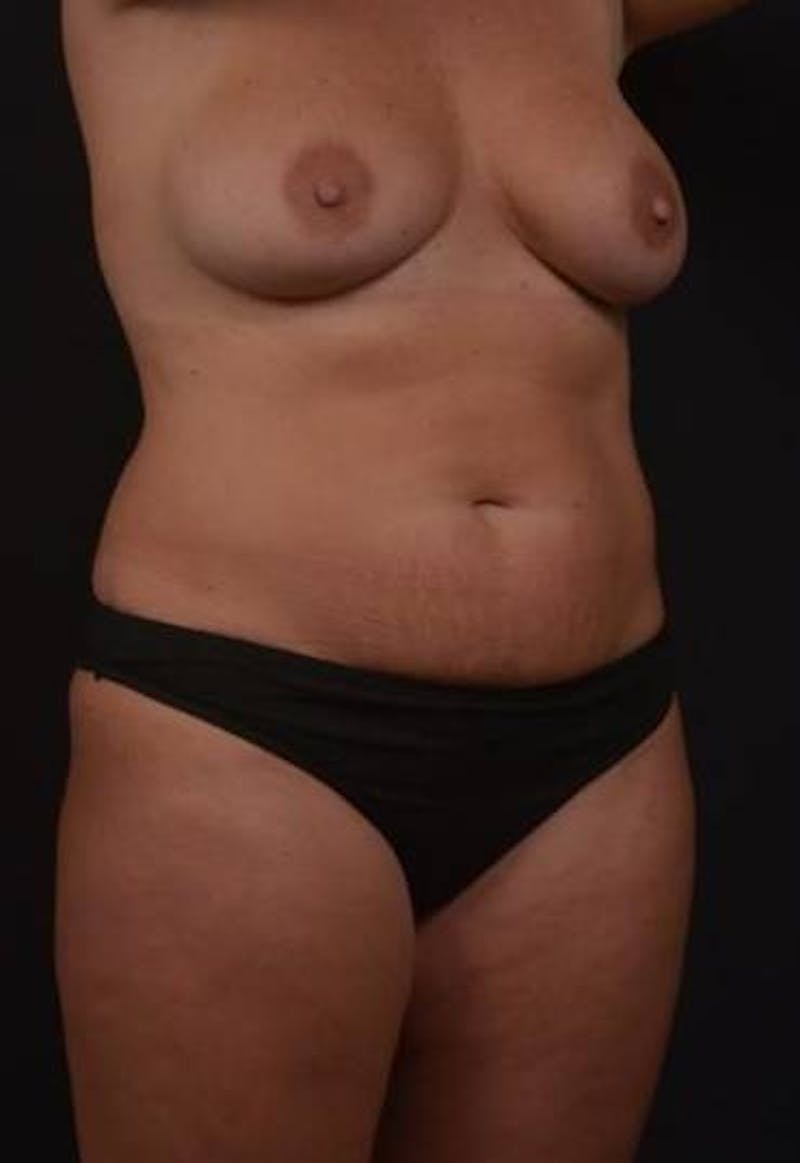 Abdominoplasty Before & After Gallery - Patient 191497 - Image 7