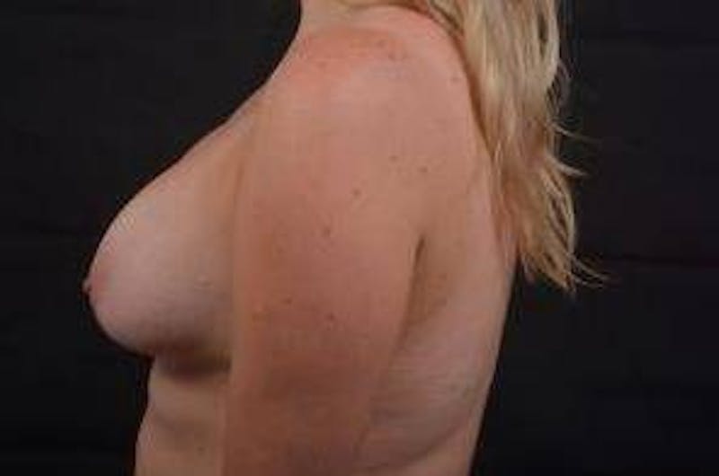 Aesthetic Breast Revision Before & After Gallery - Patient 162451 - Image 3