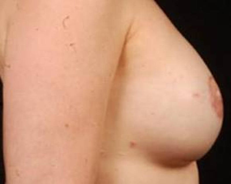 Reconstructive Breast Revision Before & After Gallery - Patient 345351 - Image 4