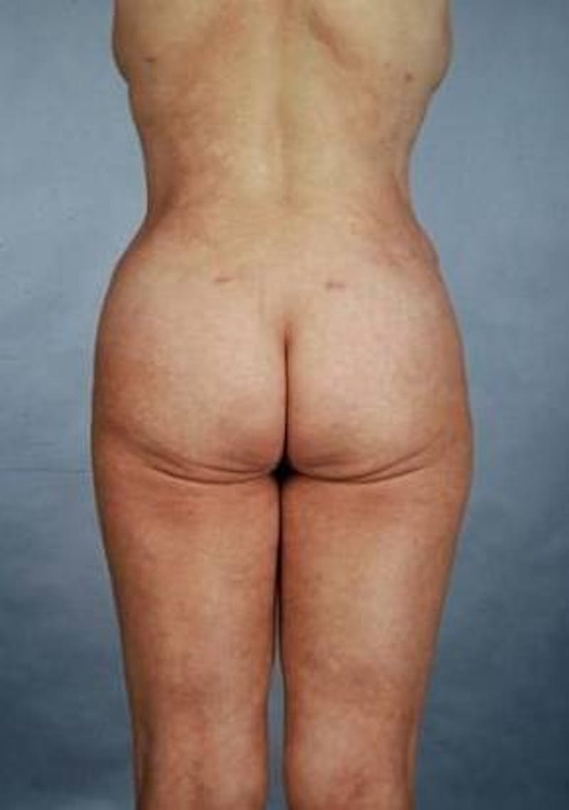 360 Liposuction Before & After Gallery - Patient 172946 - Image 2