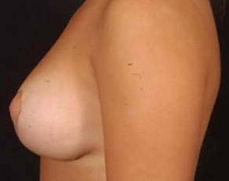 Mastopexy Before & After Gallery - Patient 368414 - Image 4