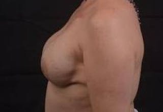 Immediate Breast Reconstruction – Nipple Sparing Before & After Gallery - Patient 199311 - Image 4