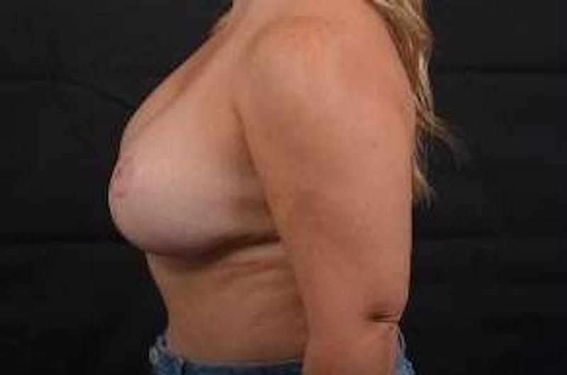 Breast Augmentation Mastopexy Before & After Gallery - Patient 991469 - Image 4