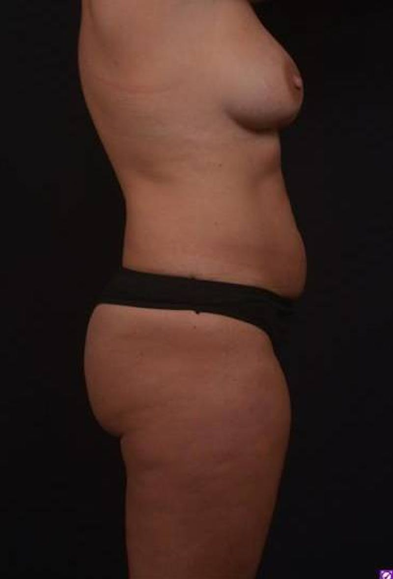 Abdominoplasty Before & After Gallery - Patient 191497 - Image 9