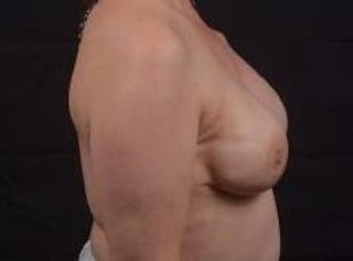 Immediate Breast Reconstruction – Nipple Sparing Before & After Gallery - Patient 199311 - Image 6