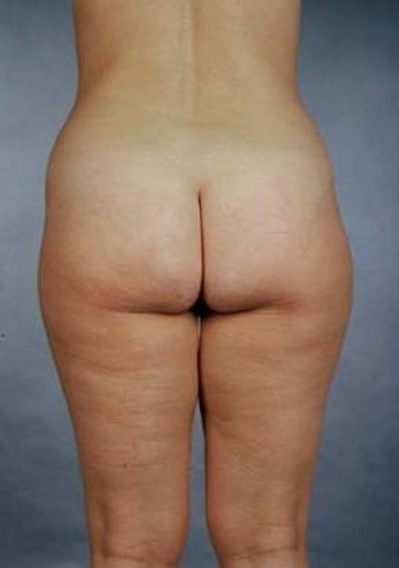 360 Liposuction Before & After Gallery - Patient 407503 - Image 3