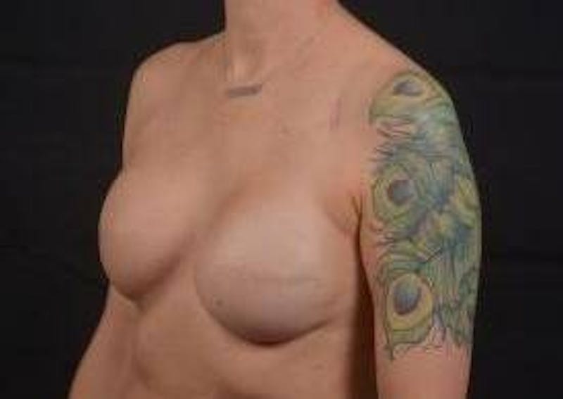 Immediate Breast Reconstruction – Skin Sparing Before & After Gallery - Patient 406784 - Image 8