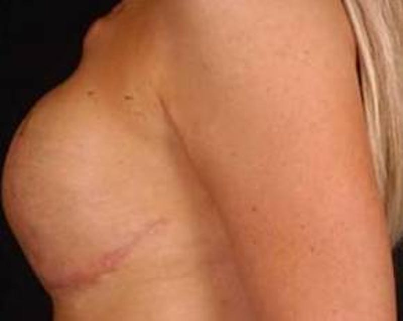 Reconstructive Breast Revision Before & After Gallery - Patient 368508 - Image 3