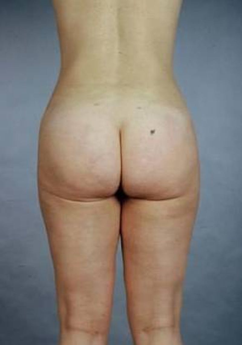 360 Liposuction Before & After Gallery - Patient 407503 - Image 4
