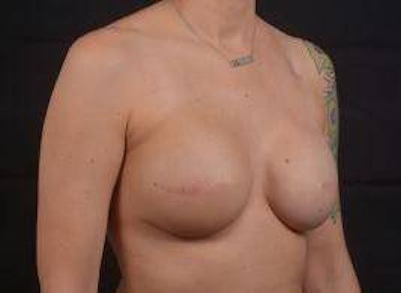 Immediate Breast Reconstruction – Skin Sparing Before & After Gallery - Patient 406784 - Image 10