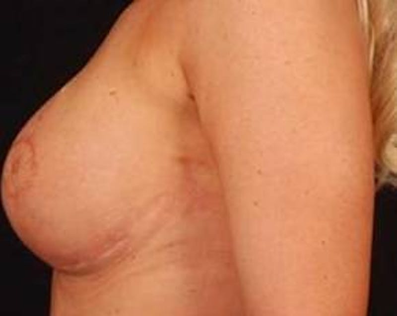 Reconstructive Breast Revision Before & After Gallery - Patient 368508 - Image 4