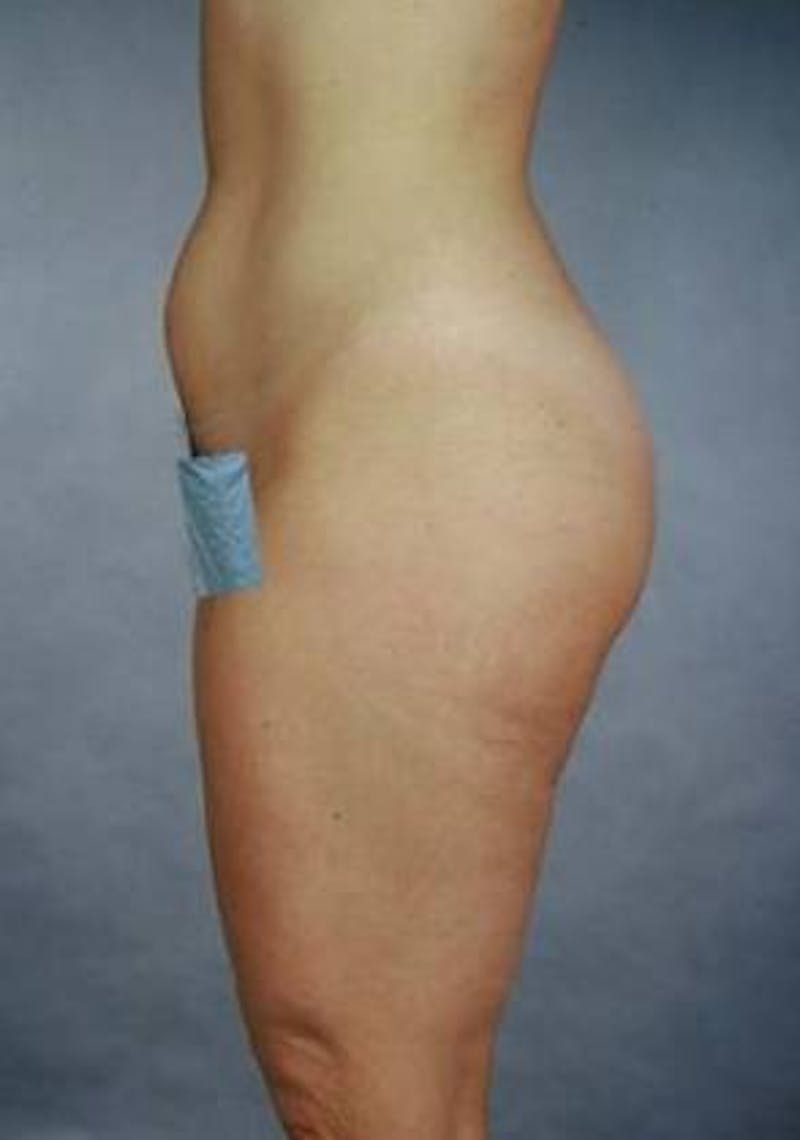 360 Liposuction Before & After Gallery - Patient 407503 - Image 5