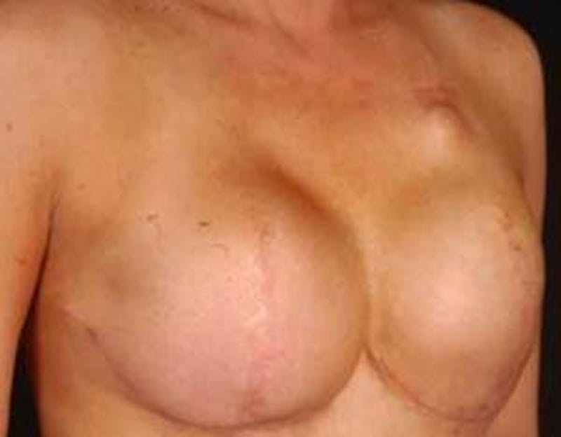 Reconstructive Breast Revision Before & After Gallery - Patient 368508 - Image 5