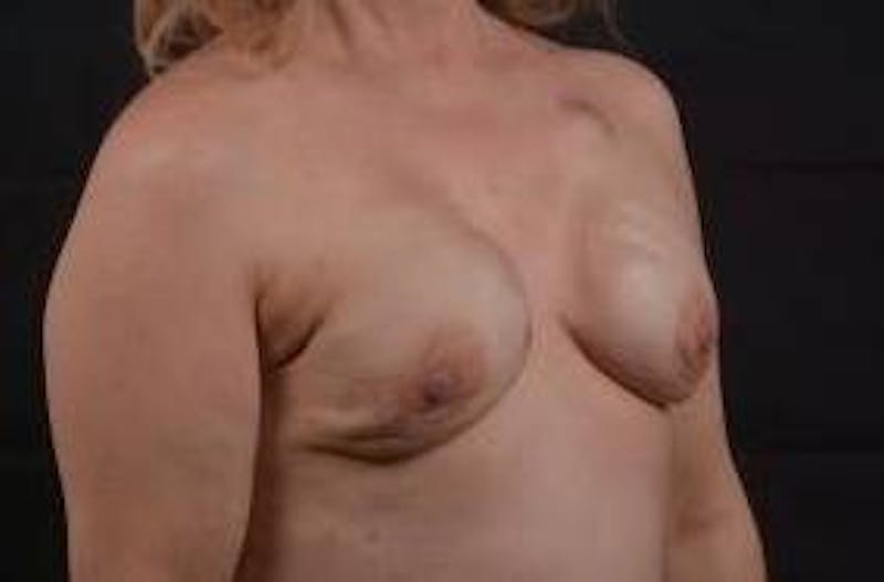 Immediate Breast Reconstruction – Nipple Sparing Before & After Gallery - Patient 199311 - Image 9