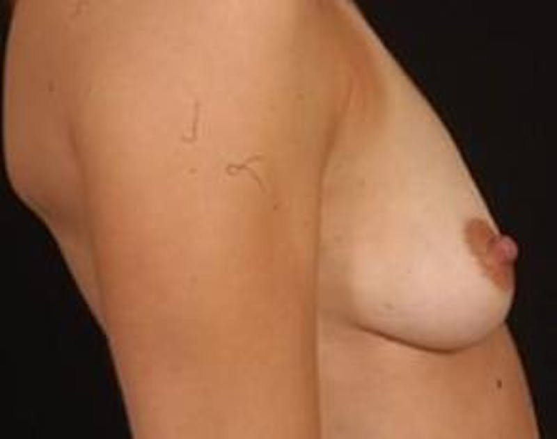 Mastopexy Before & After Gallery - Patient 131728 - Image 5