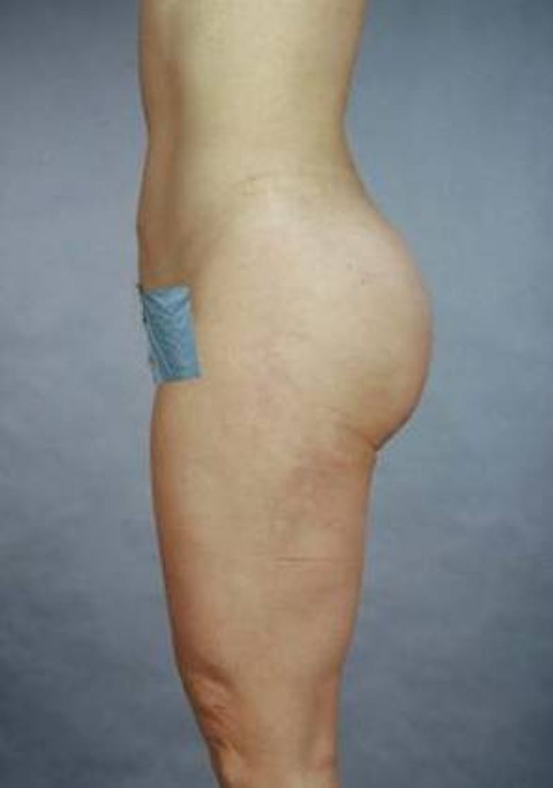 360 Liposuction Before & After Gallery - Patient 407503 - Image 6