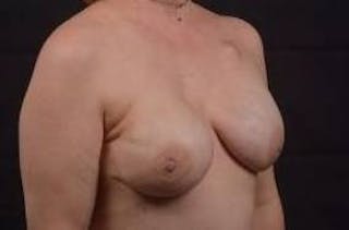 Immediate Breast Reconstruction – Nipple Sparing Before & After Gallery - Patient 199311 - Image 10