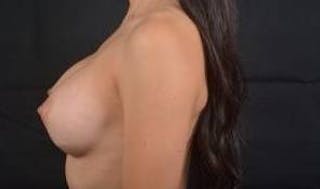 Breast Augmentation Silicone Gel Before & After Gallery - Patient 422098 - Image 4