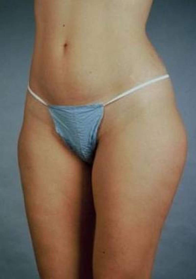 360 Liposuction Before & After Gallery - Patient 337373 - Image 3