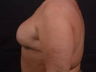 Immediate Breast Reconstruction – Skin Sparing Before & After Gallery - Patient 252977 - Image 4