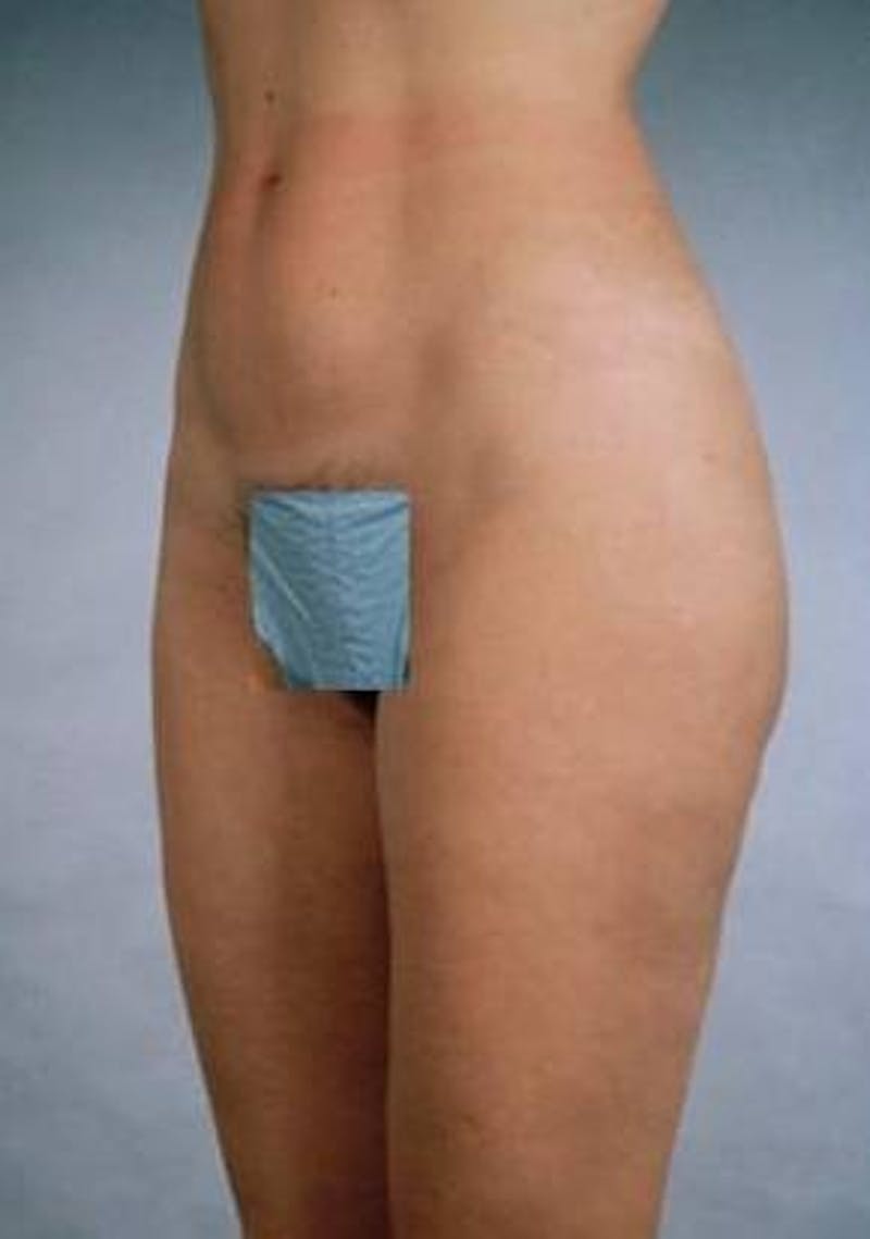 360 Liposuction Before & After Gallery - Patient 337373 - Image 4