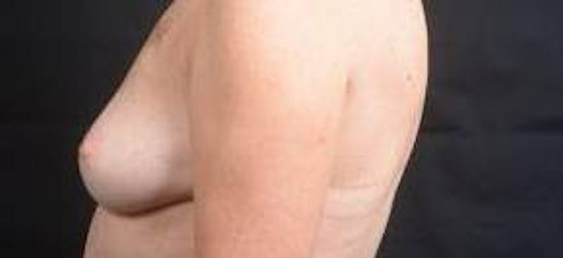 Immediate Breast Reconstruction – Nipple Sparing Before & After Gallery - Patient 280566 - Image 3