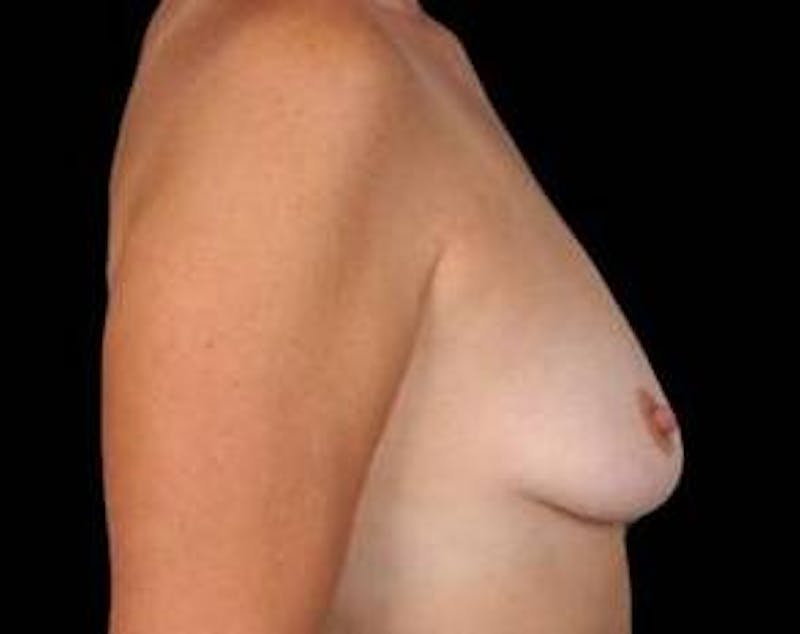 Mastopexy Before & After Gallery - Patient 354468 - Image 3