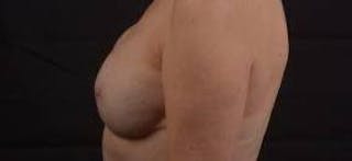 Immediate Breast Reconstruction – Nipple Sparing Before & After Gallery - Patient 280566 - Image 4
