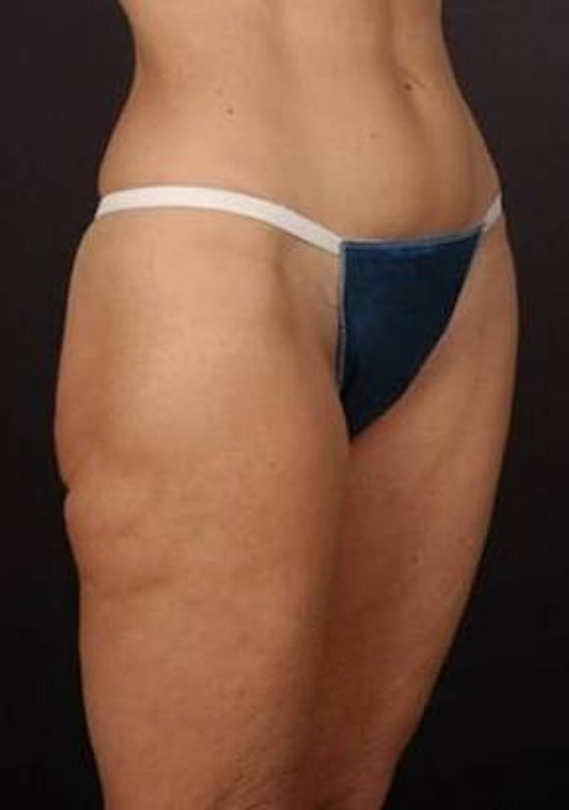 360 Liposuction Before & After Gallery - Patient 390313 - Image 3
