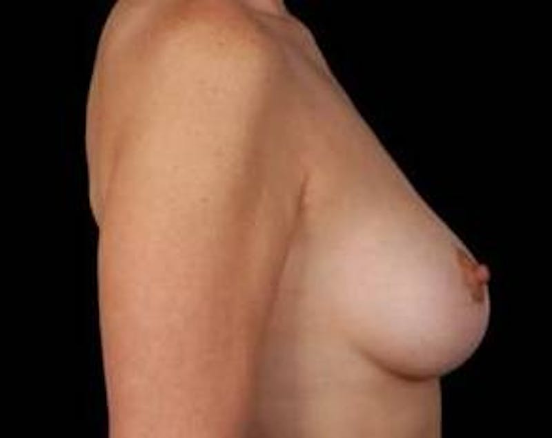 Mastopexy Before & After Gallery - Patient 354468 - Image 4