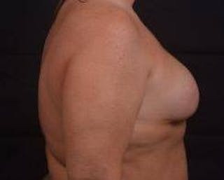 Immediate Breast Reconstruction – Skin Sparing Before & After Gallery - Patient 252977 - Image 6