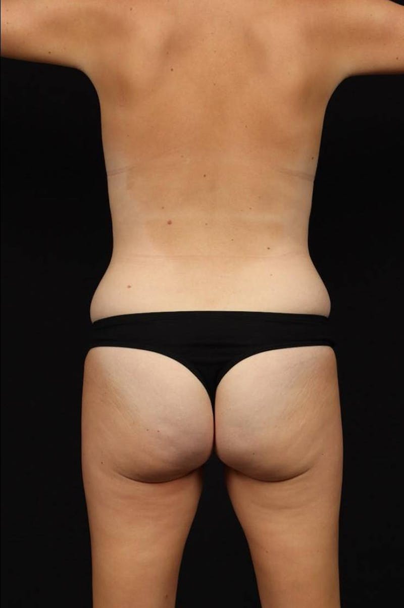 Mommy Makeover Before & After Gallery - Patient 895270 - Image 11
