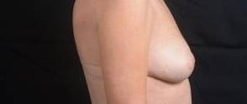 Immediate Breast Reconstruction – Nipple Sparing Before & After Gallery - Patient 280566 - Image 5