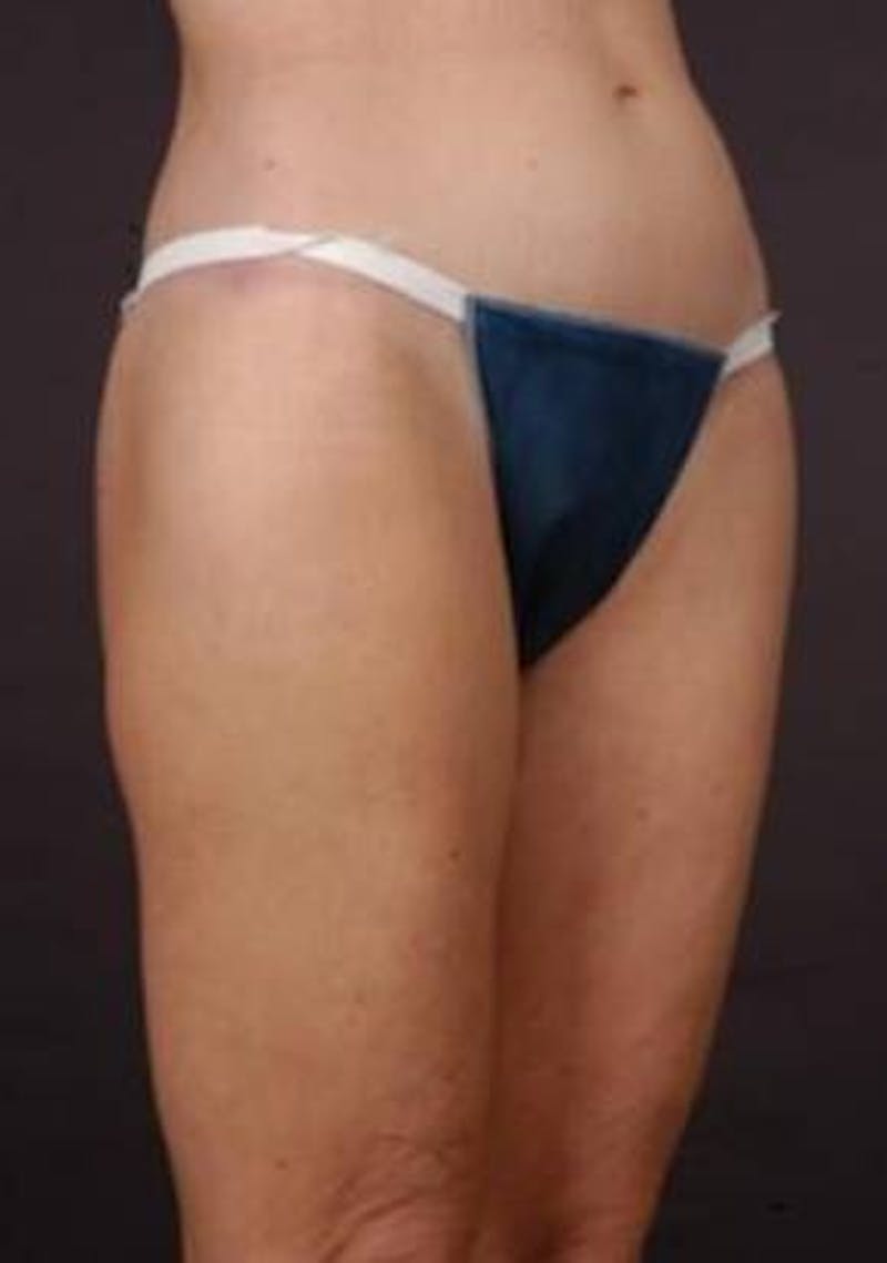 360 Liposuction Before & After Gallery - Patient 390313 - Image 4