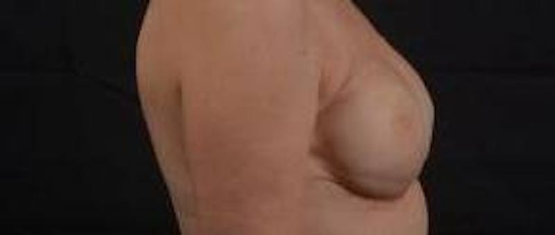 Immediate Breast Reconstruction – Nipple Sparing Before & After Gallery - Patient 280566 - Image 6