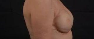 Immediate Breast Reconstruction – Nipple Sparing Before & After Gallery - Patient 280566 - Image 6