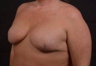 Immediate Breast Reconstruction – Skin Sparing Before & After Gallery - Patient 252977 - Image 8