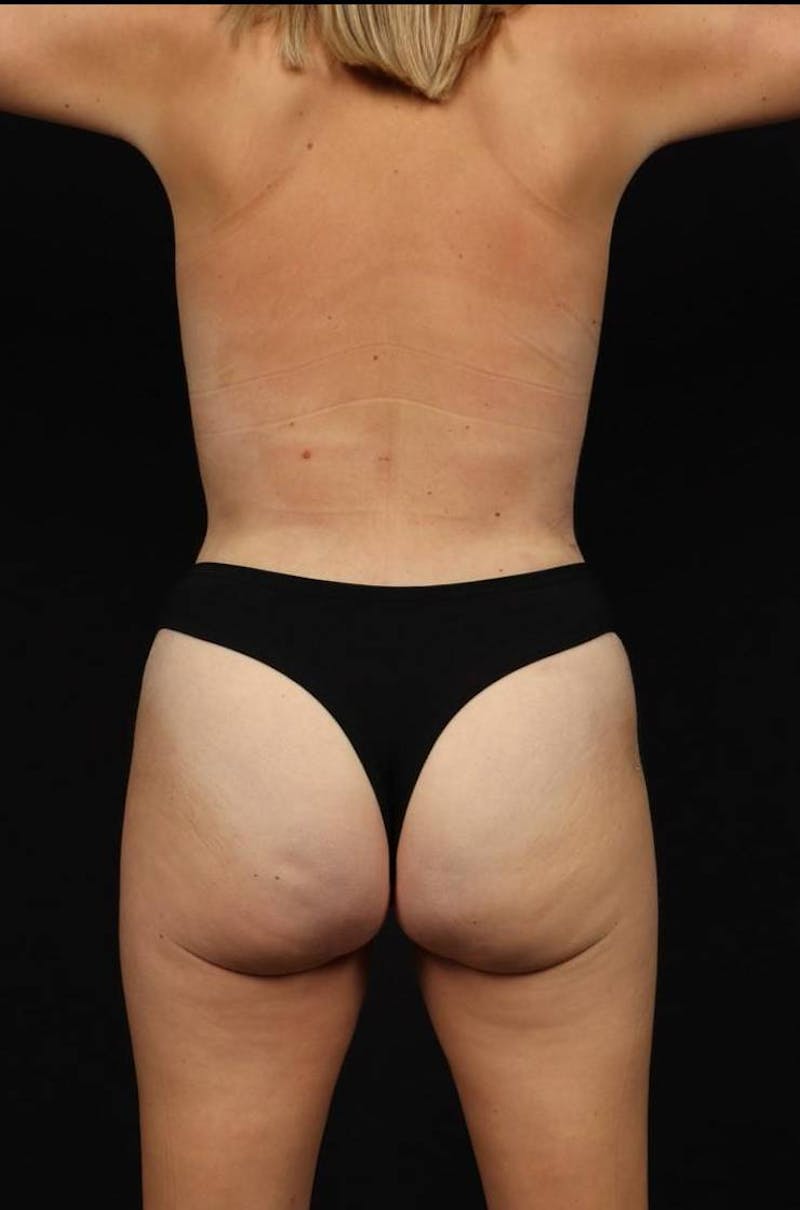 Mommy Makeover Before & After Gallery - Patient 895270 - Image 12