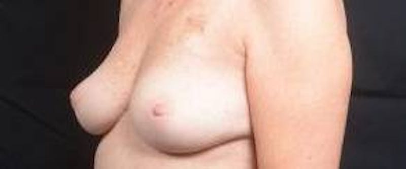 Immediate Breast Reconstruction – Nipple Sparing Before & After Gallery - Patient 280566 - Image 7