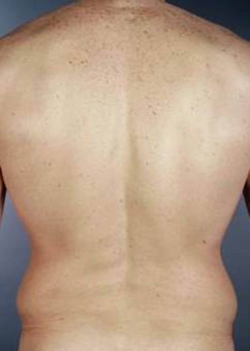 360 Liposuction Before & After Gallery - Patient 296205 - Image 3