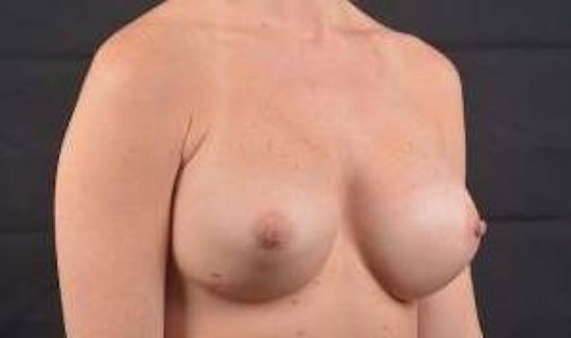 Aesthetic Breast Revision Before & After Gallery - Patient 372325 - Image 9