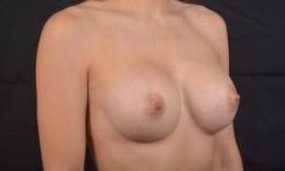 Breast Augmentation Silicone Gel Before & After Gallery - Patient 422098 - Image 10