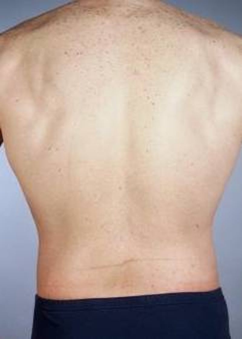 360 Liposuction Before & After Gallery - Patient 296205 - Image 4