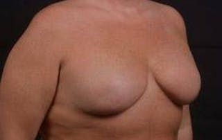 Immediate Breast Reconstruction – Skin Sparing Before & After Gallery - Patient 252977 - Image 10