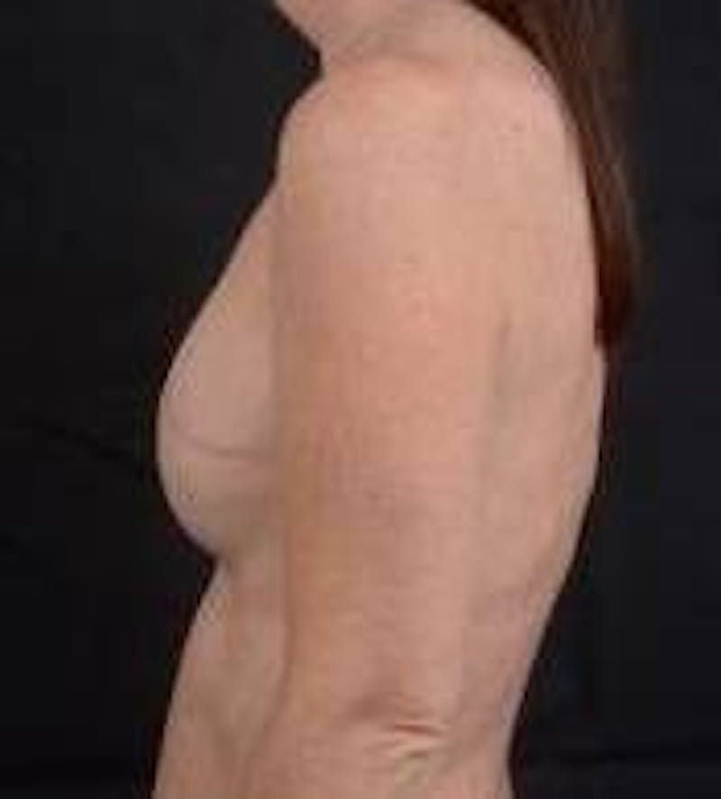 Immediate Breast Reconstruction – Nipple Sparing Before & After Gallery - Patient 148509 - Image 3